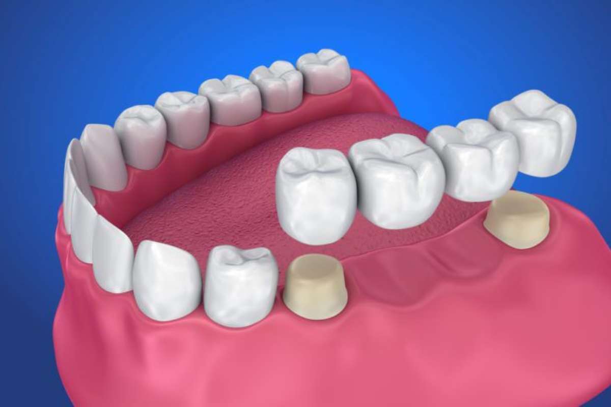 Dental Bridges and Crowns Explained by a Dentist