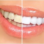 Dental Implants – A Viable Option for Seniors 