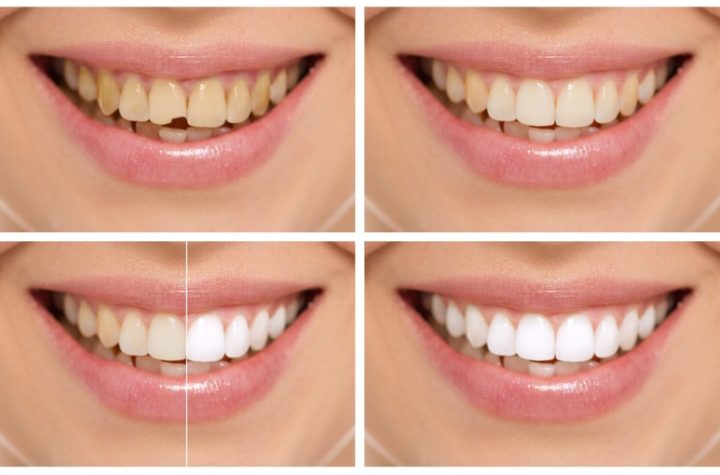 Teeth Whitening and Tooth Decay