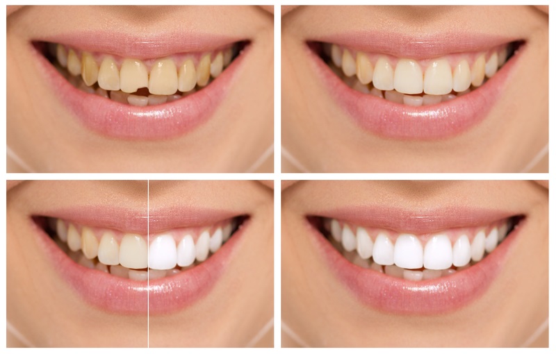 Teeth Whitening and Tooth Decay: What You Should Know Before Brightening Your Smile