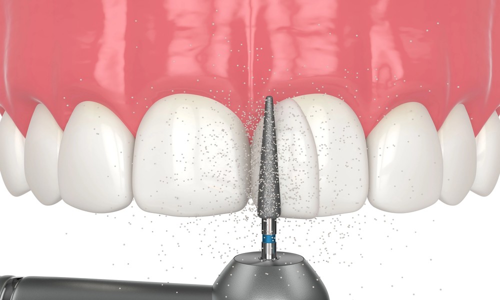What Is Teeth Bonding and When Is It Recommended?