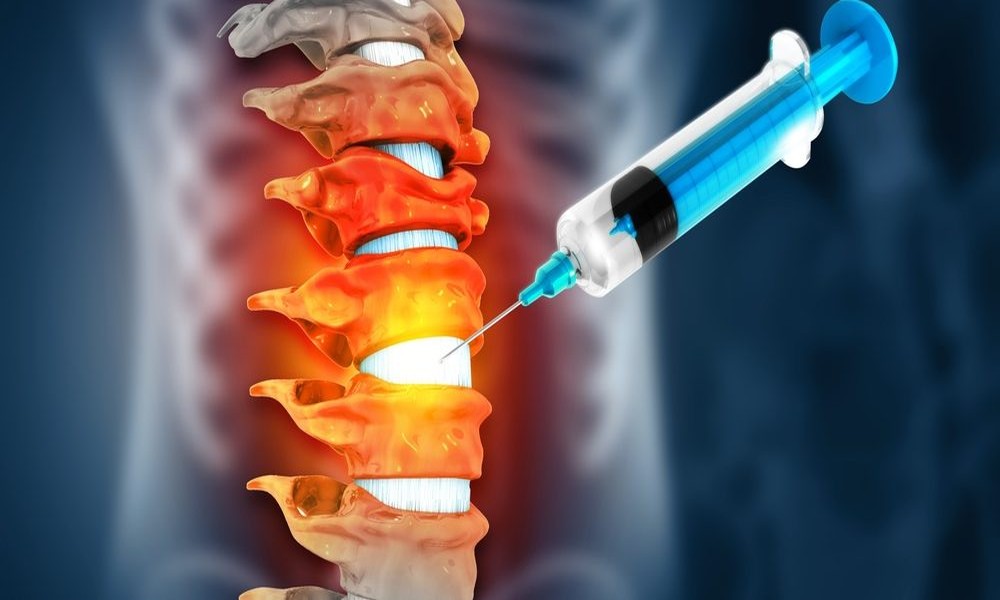 What Patients Should Know Before Getting an Epidural Steroid Injection