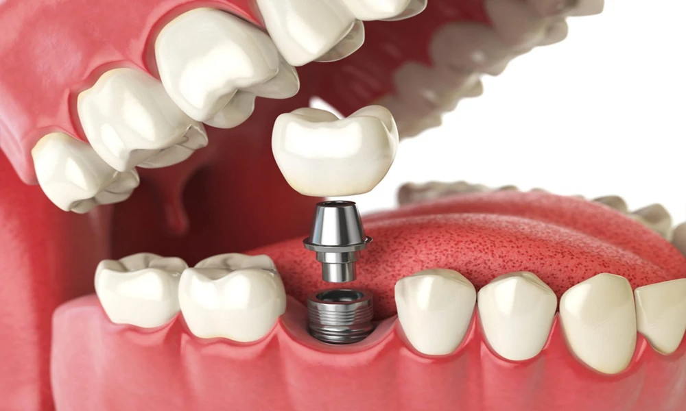 Are You a Candidate for Full Arch Dental Implants? Signs and Factors You Should Know