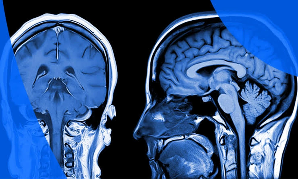 How to Read Your MRI Report: A Plain-Language Guide for Patients