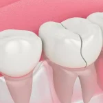Understanding Full-Arch Dental Implant Treatment