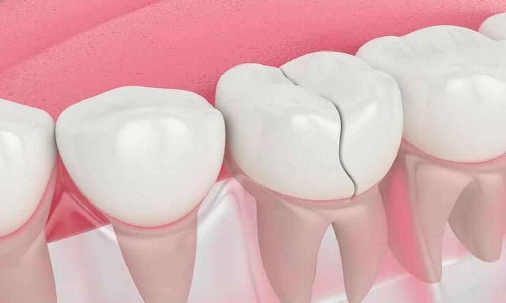 Signs Indicating That Your Cracked Tooth Requires Treatment