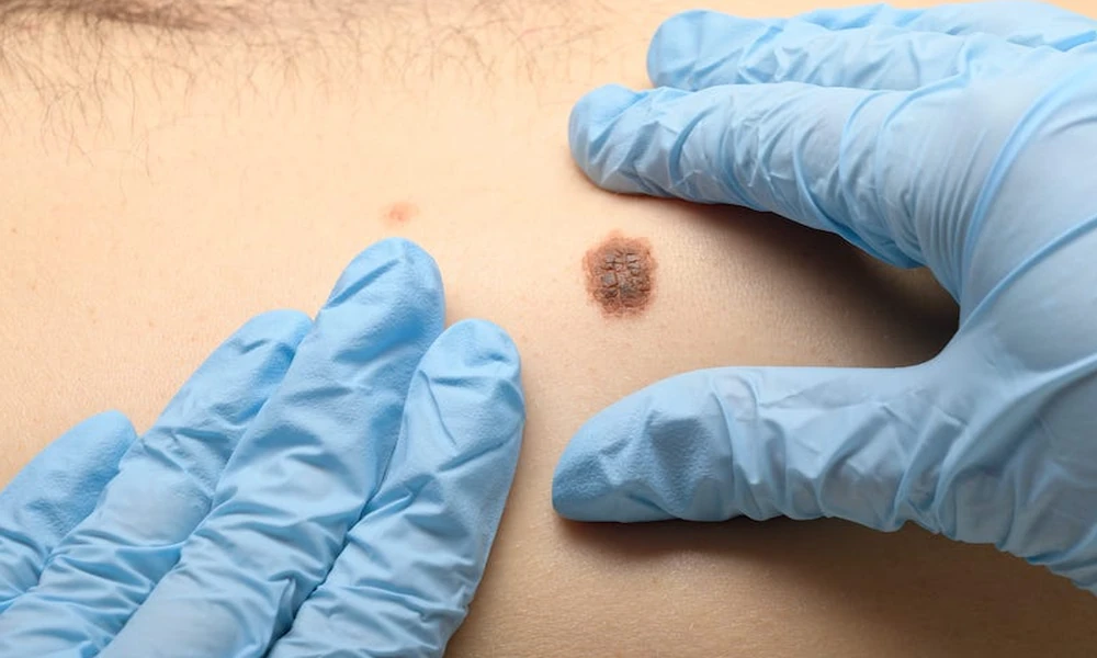 Protect Your Health: How Skin Cancer Detection Robina Catches Melanoma Early